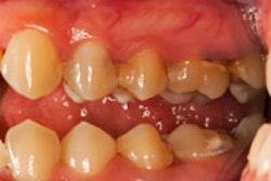 2013 07 13 09 29 53 961 Periodontal Disease Teeth 200