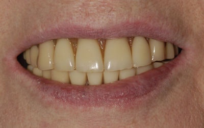 Elizabeth Scotland's implants today. Image courtesy of Dr. Paul Schnitman.