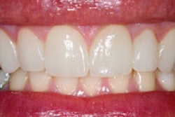 2013 08 13 13 32 43 67 Teeth Veneers 200