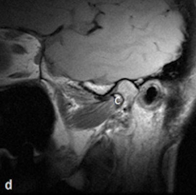 A 53-year-old woman with new left-sided TMJ pain and inability to open jaw for two months. Left column: MRI with disk outlined in white (a) and without outline (c) in closed mouth showing anteriorly displaced disk. Right column: MRI with disk outlined in white (b) and without outline (d) in open mouth showing fixed anterior displacement. All images courtesy of Dr. Lawrence Friedman.
