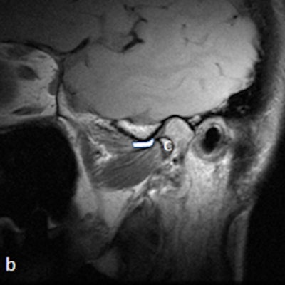 MRI with disk outlined in white in open mouth showing fixed anterior displacement