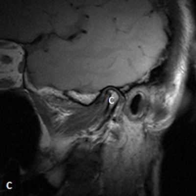 MRI with disk without outline in closed mouth showing anteriorly displaced disk