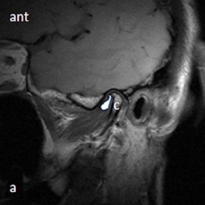 MRI with disk outlined in white in closed mouth showing anteriorly displaced disk