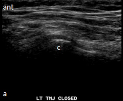 Ultrasound with disk without outline in closed mouth demonstrating anteriorly displaced disk