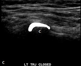 Ultrasound with disk outlined in white in closed mouth demonstrating anteriorly displaced disk