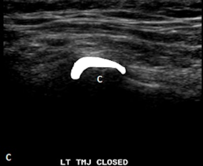 Ultrasound with disk outlined in white in closed mouth demonstrating anteriorly displaced disk