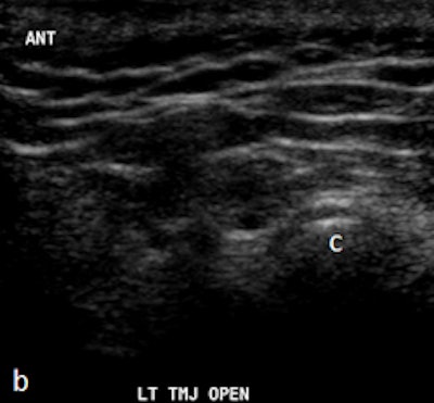 Ultrasound with disk without outline in open mouth demonstrating fixed anterior displacement