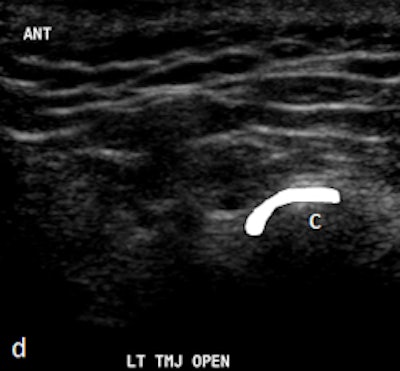 Ultrasound images in same patient as above. Left column: Ultrasound with disk outlined in white (c) and without outline (a) in closed mouth demonstrating anteriorly displaced disk. Right column: Ultrasound with disk outlined in white (d) and without outline (b) in open mouth demonstrating fixed anterior displacement.