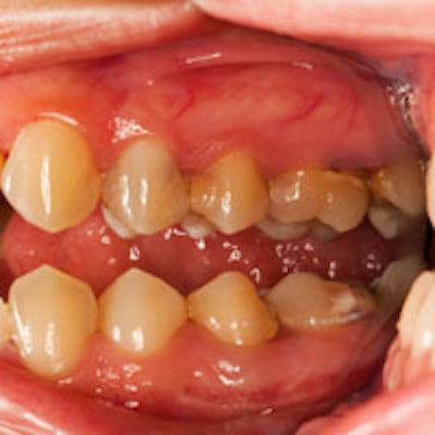 2013 07 13 09 29 53 961 Periodontal Disease Teeth 200