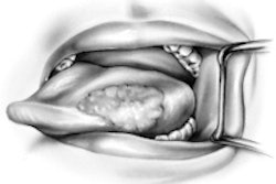 2013 10 01 15 01 52 272 Tongue Cancer 200