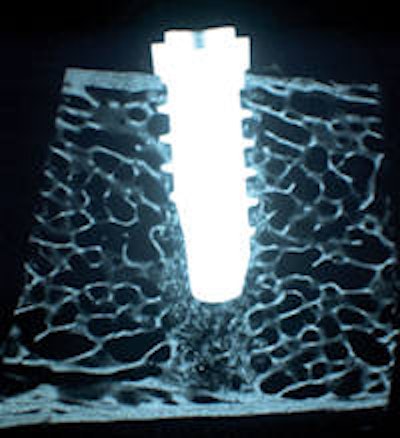 Microradiographic image of SurfLink Dental-treated implant at two weeks after placement in sheep. The implant is closely in contact with both cortical and cancellous bone. Image courtesy of NBMolecules.