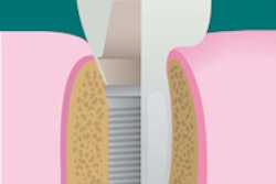 2013 05 17 15 53 36 940 Implant 200