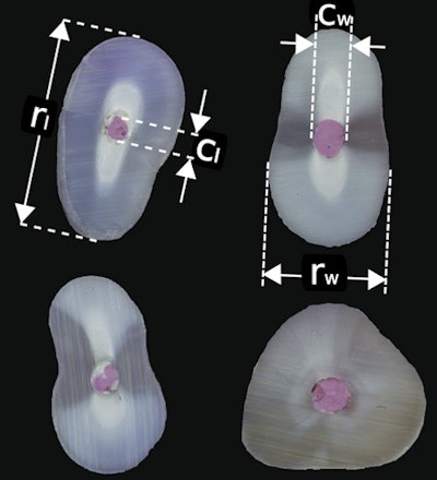 Cut faces of four root ends prior to the endodontists’ operating on them (root tips removed and pink gutta percha visible), showing some of the taken measurements. The upper left tooth shows the length of the long axis of the root acoss the root face (rl) and the length of the canal on the same axis (cl). The upper right tooth shows the width of the short axis of the root acoss the root face (rw) and the width of the canal on the same axis (cw). All the measurements were repeated after the teeth had been operated on by the endodontists, except that the central lengths and widths across the root face were of the cavities.