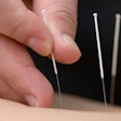 2013 12 10 15 10 18 413 Acupuncture 200