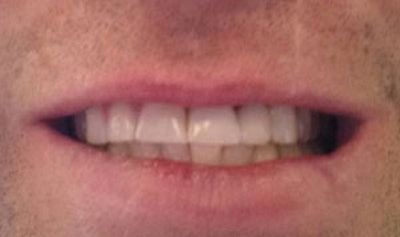 Top: Dr. Hatch after the extraction and before the implant placement. Bottom: One week after the extraction, bone graft, and implant placement. 'Things are healing well, and I got my new fake tooth,' Dr. Hatch said.