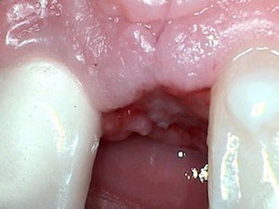 Dr. Hatch before implant