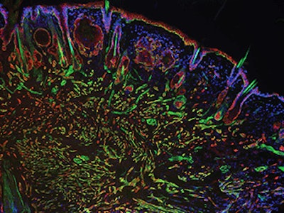 Interfering with cancer. A section of a head and neck tumor -- red and green markers show the proliferation of cancer stem cells -- that formed when one of several newly characterized genes, Myh9, was suppressed. A recently developed genetic screening technique using RNA interference identified Myh9's protein, myosin IIa, as playing an important role in tumor suppression. Image courtesy of Rockefeller University.