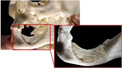 If the mandible is damaged by cancer, an infection, or an accident, it may be a long time before the bone cells start growing into the scaffolding. The pace can be accelerated by adding the patient's own bone progenitor cells. Image courtesy of the University of Oslo.