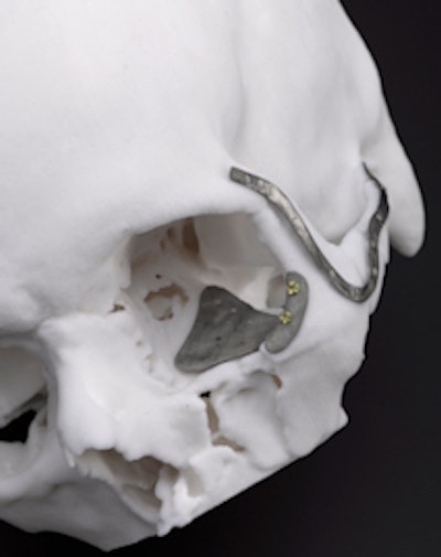 Rendering of the printed titanium plates