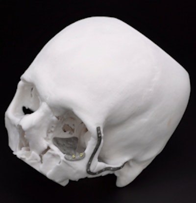 A rendering of the printed titanium plates used to reconstruct Stephen Power's face after a motorcycle accident. Images courtesy of the Science Museum.