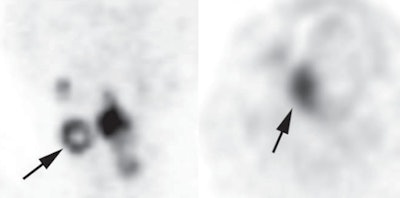 Left PET image shows typical ring-shaped uptake (arrow) in metastatic lymph node of a 54-year-old woman with hypopharyngeal squamous cell carcinoma. Sphere-shaped uptake shown at right is from a primary lesion in a 55-year-old man with SCC of the oral cavity. Images courtesy of AJR.
