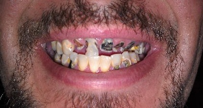 Before he was seen by a RAW dentist, this Iraqi vet's mouth showed signs of deterioration. Image courtesy of RAW.