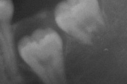 2013 12 18 17 31 50 654 Third Molar 200