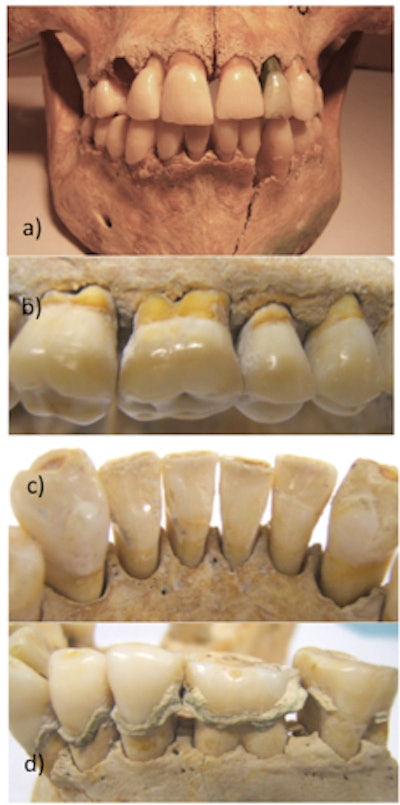 (a) A 25-year-old female, buried around 350 A.D. Periodontally healthy but some postmortem damage evident. She had been buried with a copper coin in her mouth resulting in the tooth discoloration seen in upper left second incisor. (b), (c) Periodontally healthy samples with normal crestal alveolar bone contour and intact cortical plates. (d) Extensive calculus deposits. Note also single infrabony defect mesial to lower second molar. Image courtesy of the British Dental Journal.