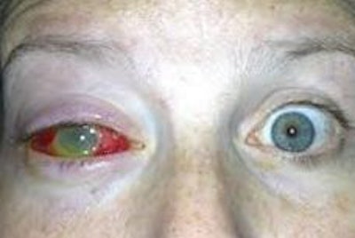 Immediately after the operations to save Morrone's vision.