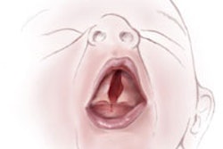 2014 10 29 15 55 21 552 Cleft Palate 200