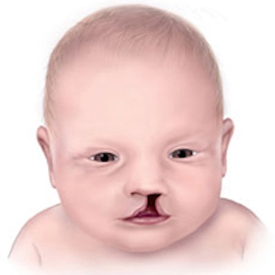 Baby with cleft lip