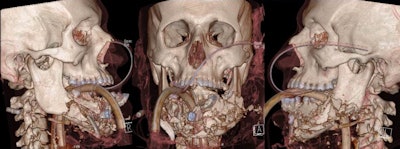 With the help of CT and 3D printing, the doctors printed a custom-made jaw implant out of titanium. Above CT images of the patient. Below, 3D reconstructions with the jaw implant.