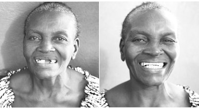 A woman in Haiti smiles after receiving her new dentures.