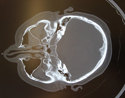 Preoperative CT scan (above) shows a left-sided zygomaticomaxillary complex fracture that is moderately displaced and rotated. After sublabial access and mobilization, reduction is confirmed with intraoperative CT (below). Reduction has been achieved and no further incisions are necessary.