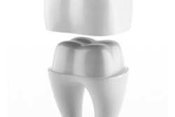 2015 02 02 11 00 10 133 Crown Tooth 200