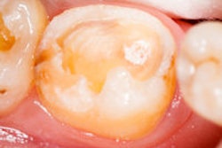 2015 03 10 11 52 16 989 Teeth Untreated 200