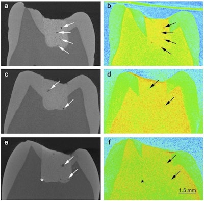 Left: X-rays of teeth with fillings of glass ionomer cement show how porous the cement is. Right: Images of the same teeth using neutron scattering show how the pores are filled with liquid. Credit: Benetti AR et al, DOI:10.1038/srep08972 (2015).