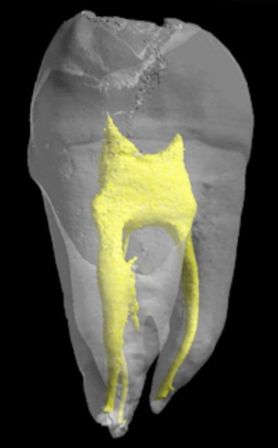 3D model of a tooth, with the pulp in yellow. Image courtesy of INSERM.
