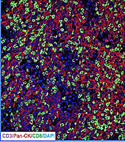 Pembrolizumab. All images courtesy of University of Chicago Medical Center.
