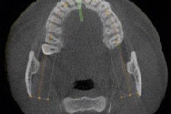 2015 06 18 11 08 15 578 2015 06 25 Cbct Implant Thumb