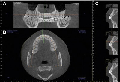 Reformatted CBCT views. A: Reformatted panoramic view demonstrates that the occlusal plane is parallel to the floor. B: Axial view at the maxillary arch level. The green lines are perpendicular to alveolar ridge. They indicate where the cross sectional views were taken. C: Series of cross-sectional views. The view in the middle panel (corresponding to the middle green line in B) was used for alveolar volume and buccal undercut measurements. Zhang et al. BMC Oral Health 2015 15:65 doi:10.1186/s12903-015-0055-1.