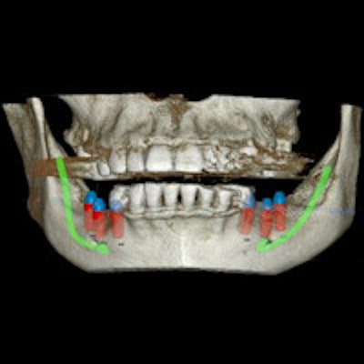 2014 12 18 10 41 03 613 Cbct 3 D Implants 200