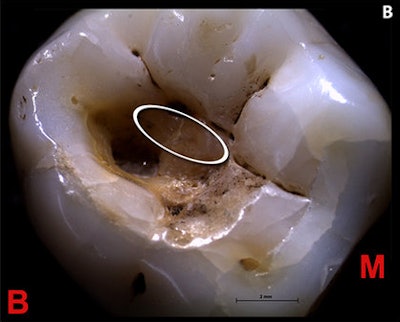 Stereo microscopical image of right third molar with magnification of the cavity and of the region (elipse) containing the striations described.