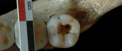 Occlusal view of the right third molar. All images courtesy of Scientific Reports.