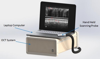 The solar-powered portable screening device developed by UC Irvine researchers uses optical coherence tomography to analyze oral lesions.