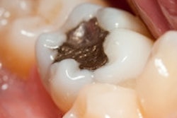 2014 06 16 13 17 18 964 Amalgam Filling 200