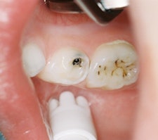 Two teeth treated with silver diamine fluoride. The tooth on the right shows caries that have been arrested, while the tooth on the left shows arrested incipient caries. Image courtesy of Steven Duffin, DDS.