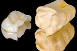 2016 01 14 11 28 24 718 Tooth Ceramic Inlay 200