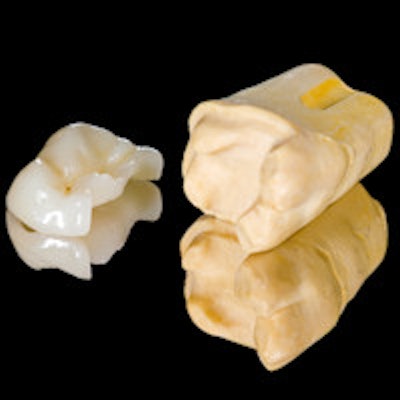 2016 01 14 11 28 24 718 Tooth Ceramic Inlay 200