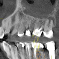 2016 03 15 14 57 56 831 2016 03 16 Cbct Fig8 Thumb